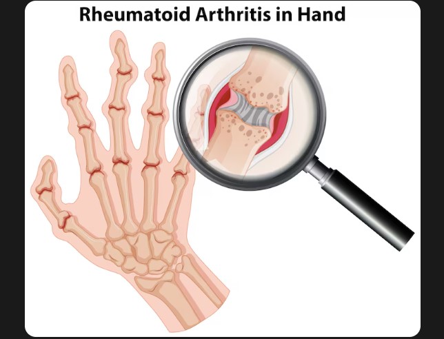 Best Arthritis Treatment in Dombivli